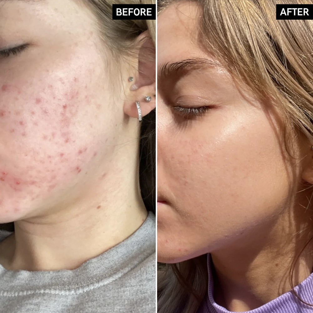 The INKEY List beta hydroxy acid Serum