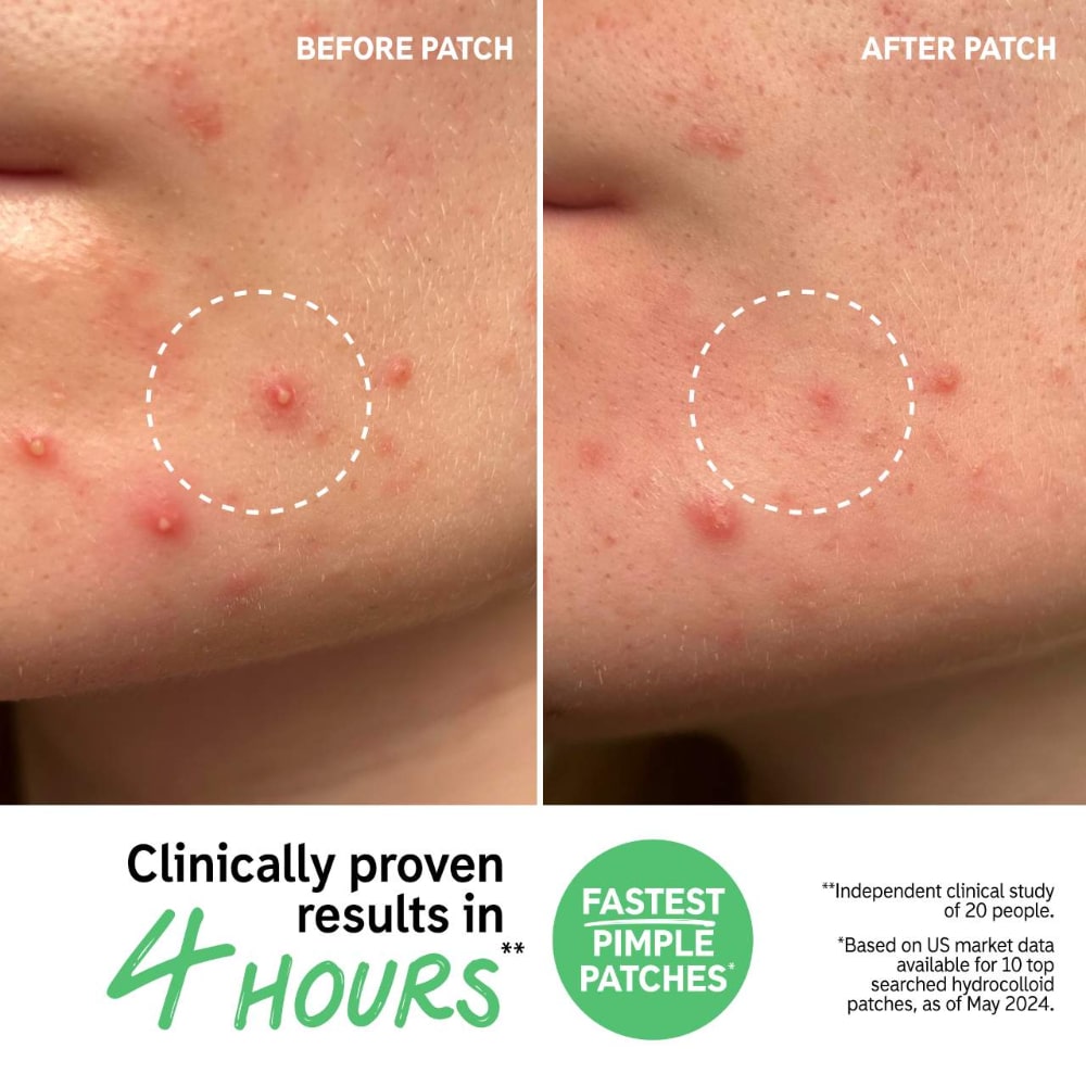 The INKEY List Hydrocolloid Invisible Pimple Patches