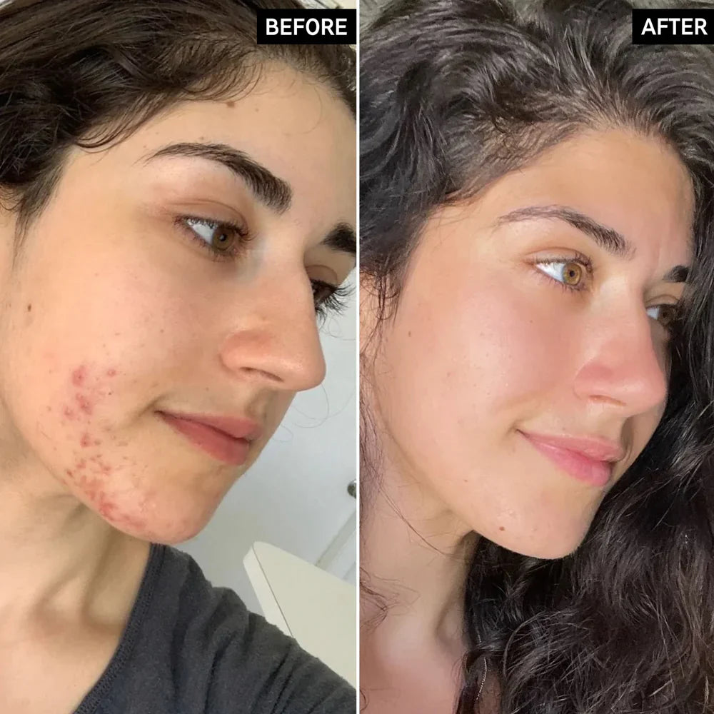 The INKEY List Succinic Acid Acne Treatment (without box)