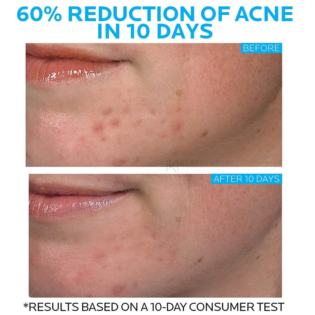 La Roche Posay Effaclar Duo Acne Spot Treatment