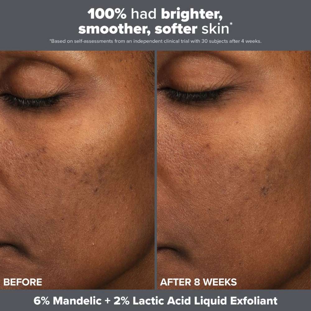 Paula’s Choice Skin Perfecting Mandelic & Lactic Acid Liquid Exfoliant