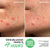 The INKEY List Hydrocolloid Invisible Pimple Patches